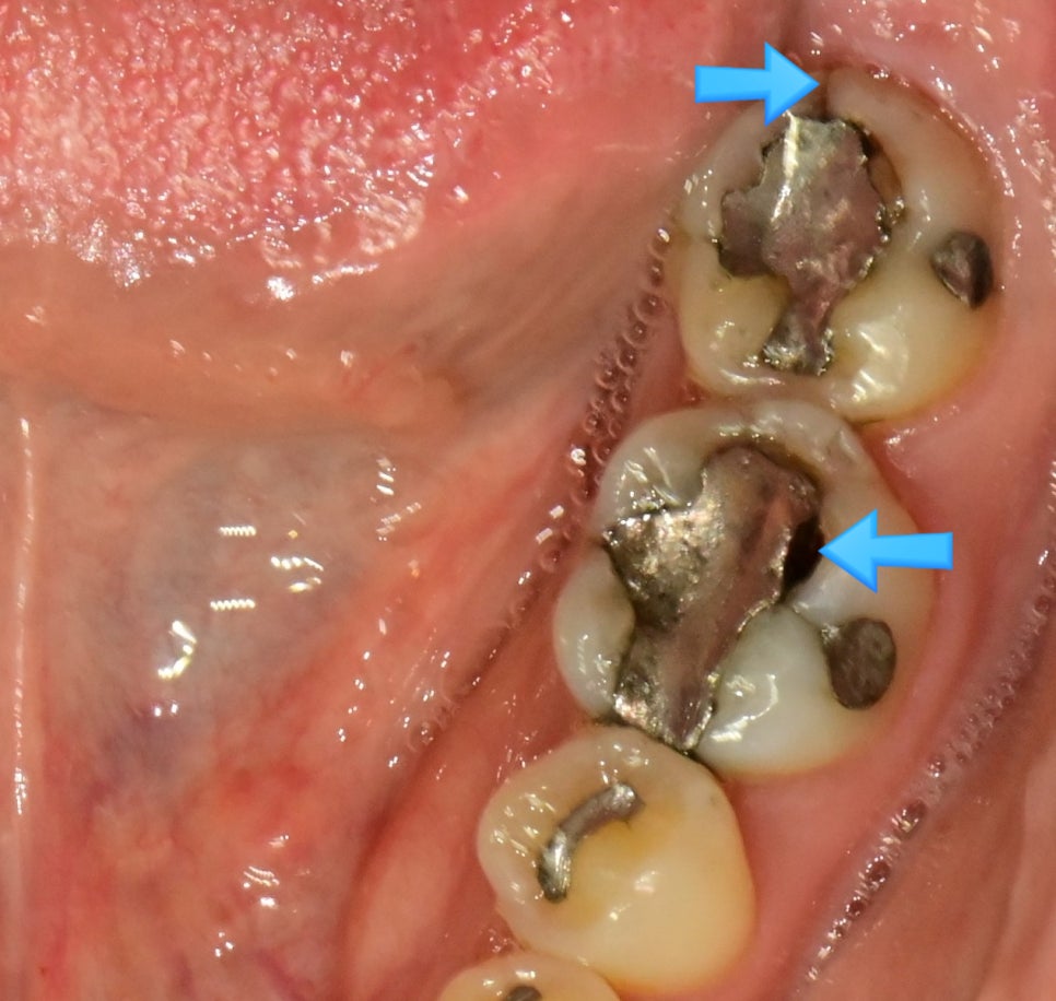 두 치아의 대형 아말감 — 변연 파절과 균열이 화살표로 표시된 임상 사진