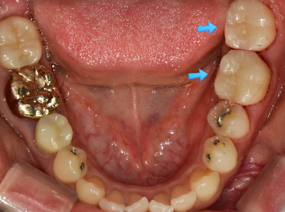 크라운 치료 후 하악 교합면 — 아말감 교체 부위 크라운 접착 완료 사진