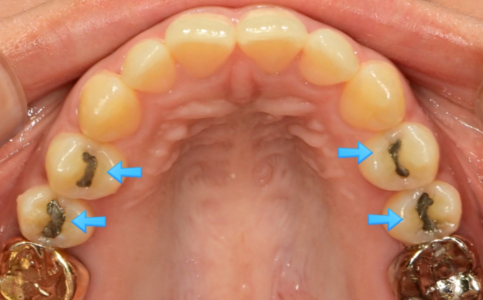 상악 교합면 사진 — 4개 치아에 아말감 충전물이 파란 화살표로 표시된 before 임상 사진