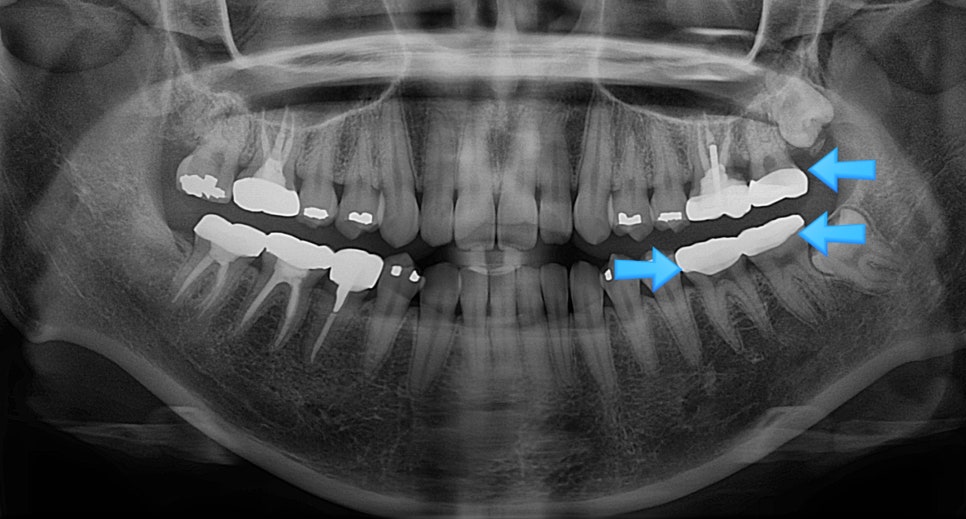 파노라마 X-ray — 3개 화살표로 아말감 교체 크라운 치료 부위 표시된 전체 구강 방사선 사진