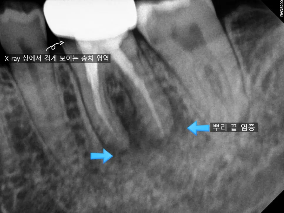 뿌리 끝 염증이 확인되는 진단 엑스레이