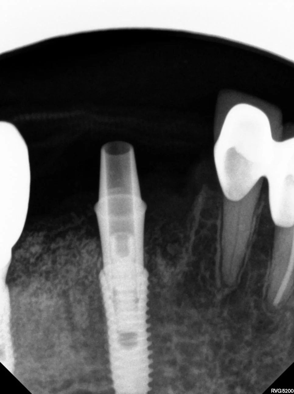 치근단 X-ray - 임플란트와 인접 자연치 상태 확인
