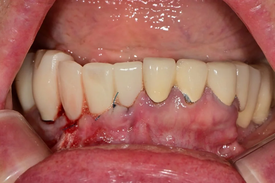 발치 및 임플란트 2차 수술 후 봉합 구내사진