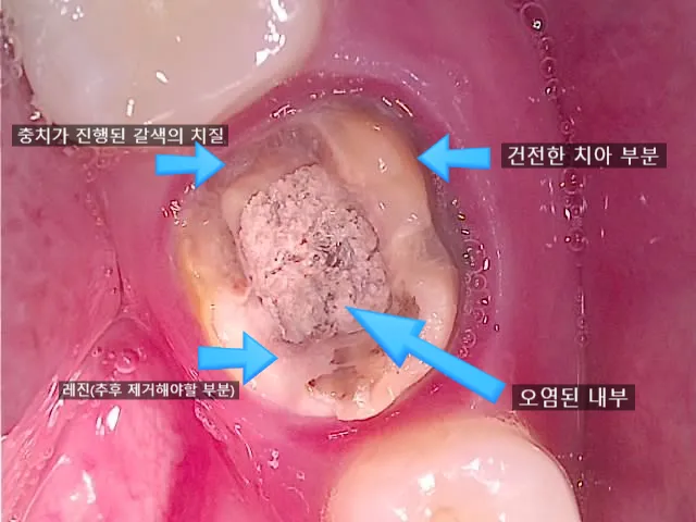 크라운 내부 충치와 오염 상태