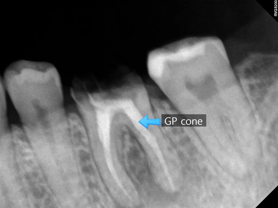 신경관 길이 측정 및 확인 과정