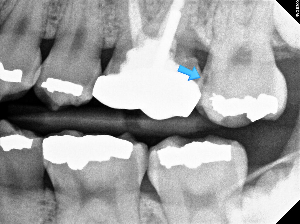 치근단 X-ray — 아말감 하방 이차 우식 의심 부위에 파란 화살표 표시된 방사선 사진