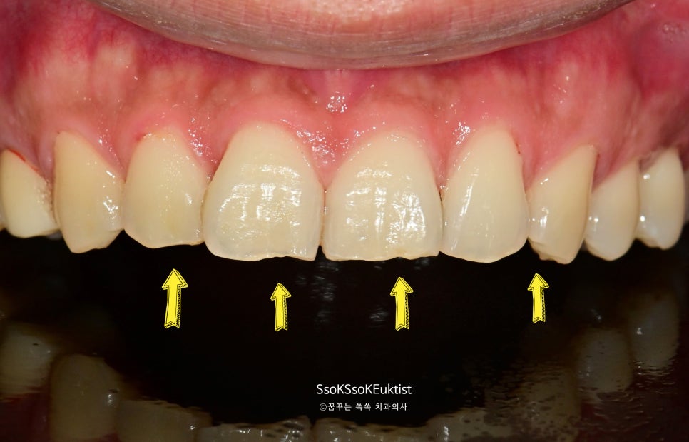 심한 이갈이로 앞니까지 마모된 치아 상태