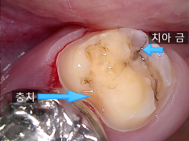 아말감 제거 후 드러난 치아 내부 — 한글 주석으로 치아 금(crack)과 충치 부위 표시
