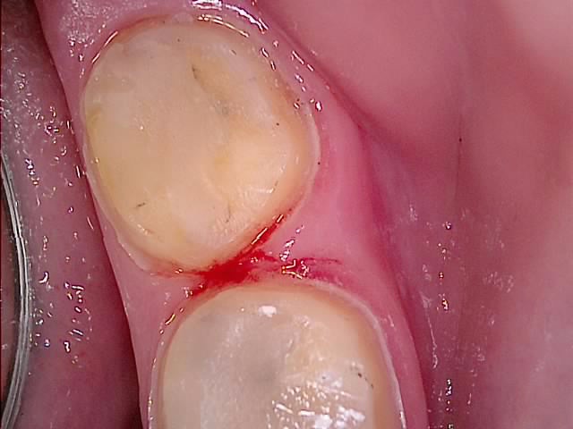 와동 다른 각도 임상사진 — 인접면 삭제 및 와동 형성 상태 기록