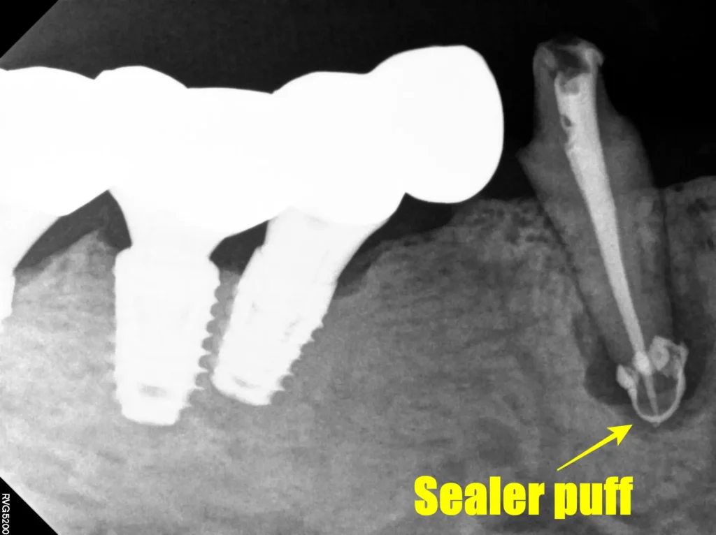재신경치료 완료 후 PA view, sealer puff가 만들어지고 잘 치료 됨.