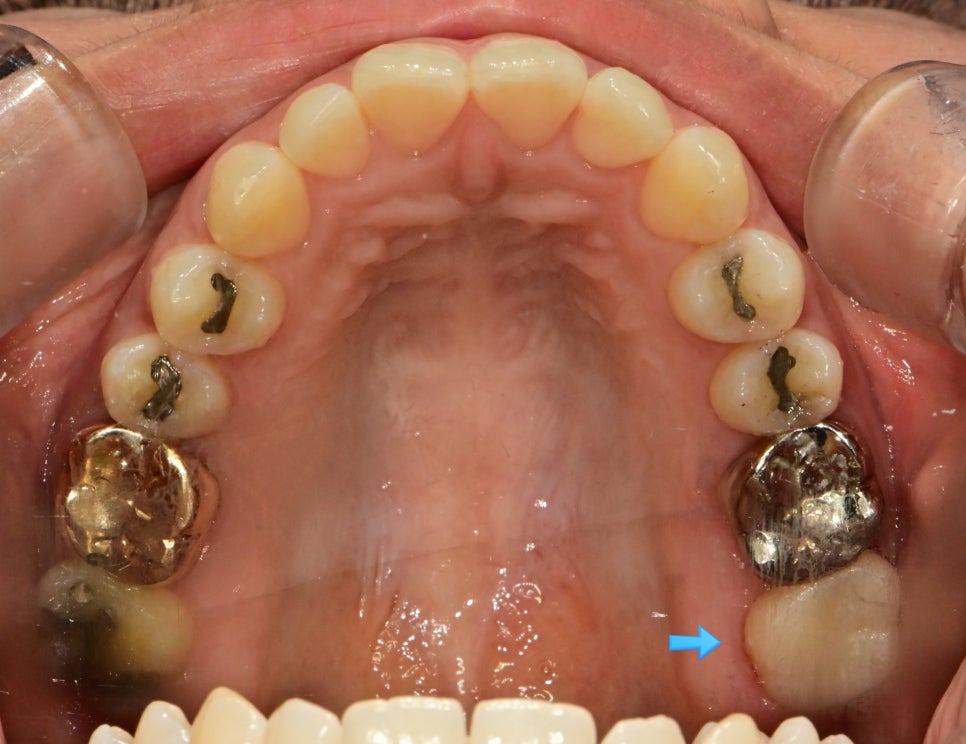 크라운 치료 후 상악 교합면 — 아말감 교체 부위 크라운 접착 완료 사진