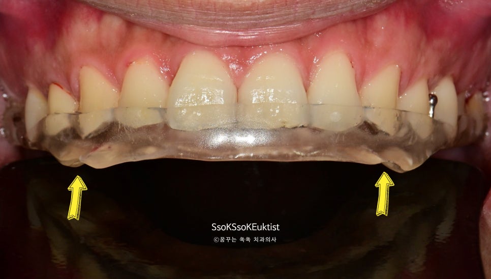 장기간 사용으로 닳아버린 이갈이 스플린트
