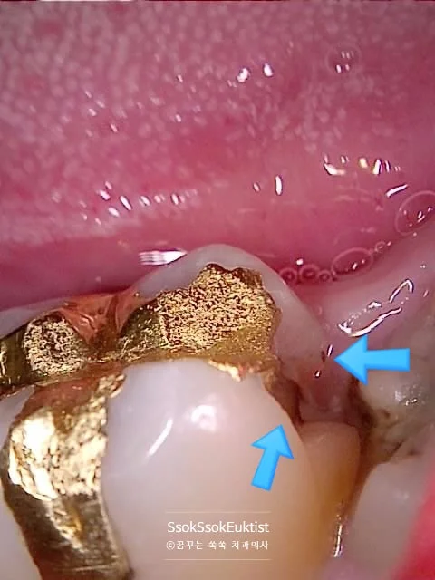 사랑니 인접 어금니 충치 육안 확인