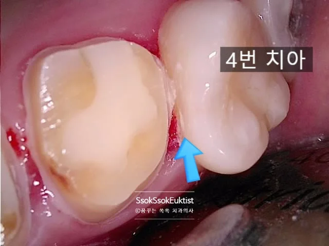 인접 치아 충치 확인 임상 사진