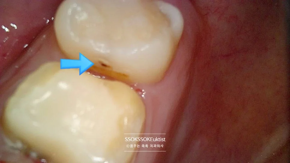 크라운 치료 중 인접면 충치 발견