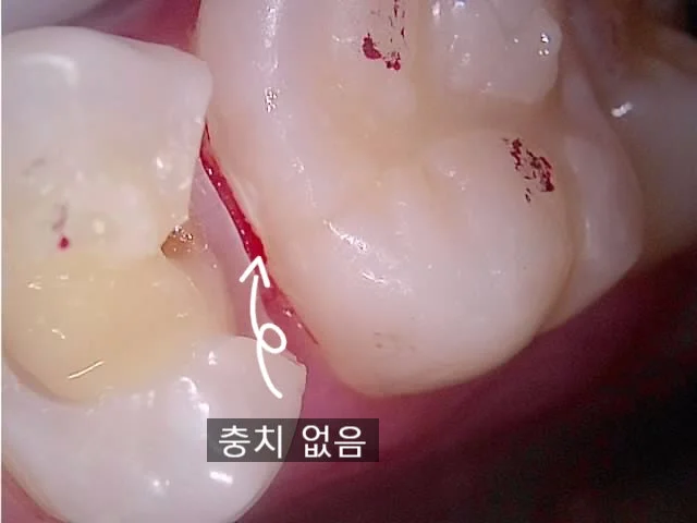 인접 치아 충치 없음 확인 사진