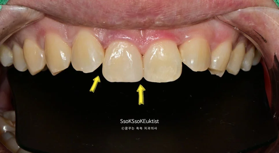 앞니 레진 치료 완료 후 자연스러운 최종 결과