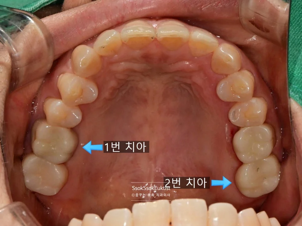 크라운 접착 후 결과 1