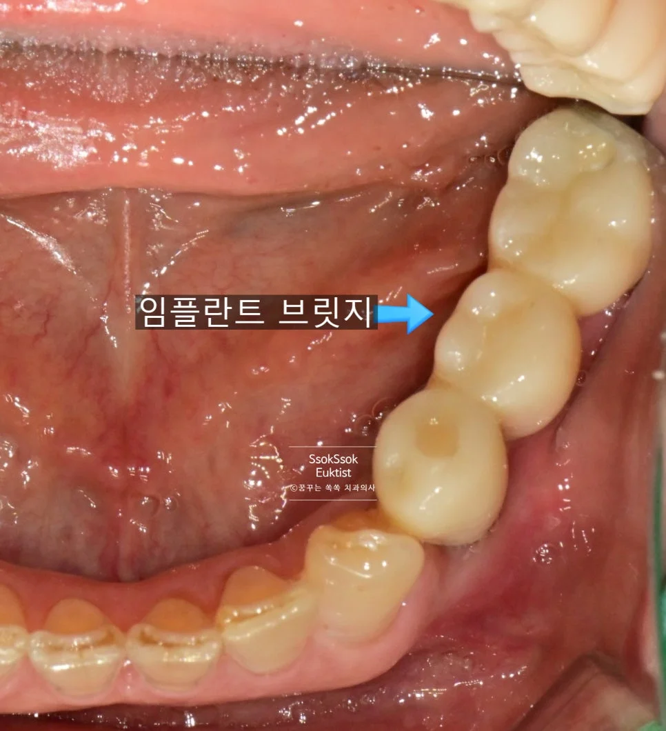 임플란트 보철물 장착 완료 후 최종 결과 사진
