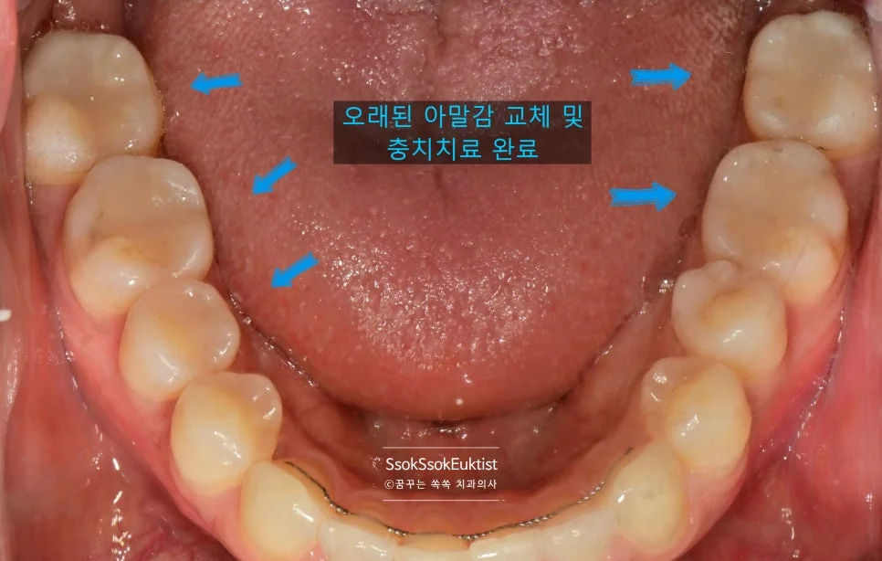 인레이 치료 완료 후 왼쪽 치아 상태 깨끗한 모습 임상사진