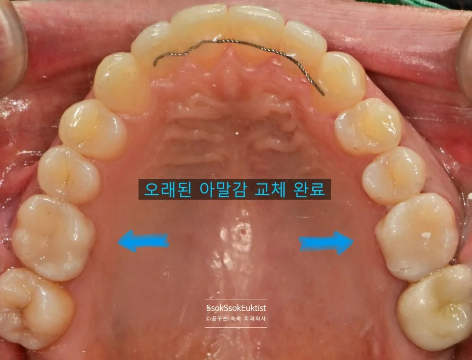 인레이 치료 완료 후 오른쪽 치아 상태 임상사진