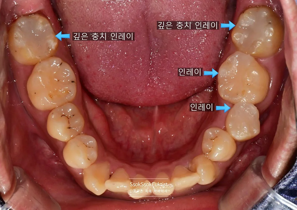 치료 후 하악 결과 라벨