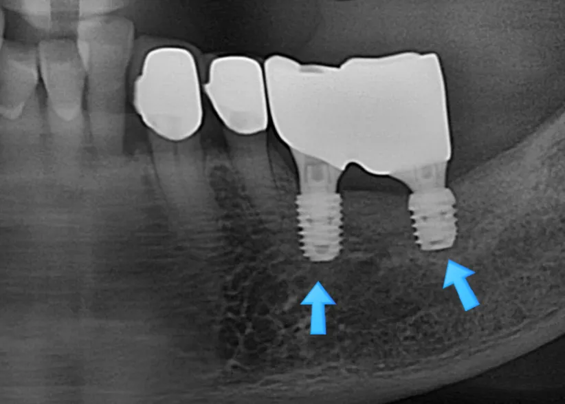 재식립 후 임플란트 안정적 고정 확인 엑스레이