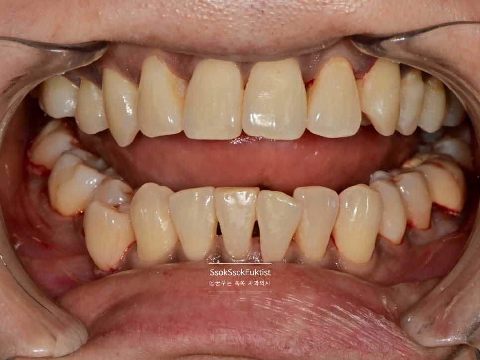 수면 스케일링 후 깨끗한 치아