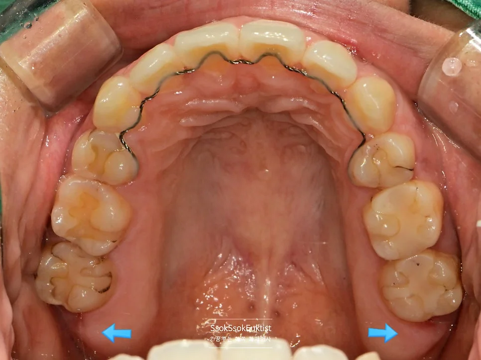 치료 완료 후 결과 1
