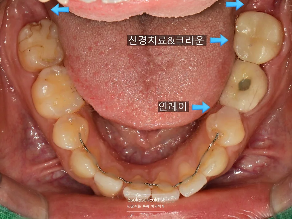 치료 완료 후 결과 2