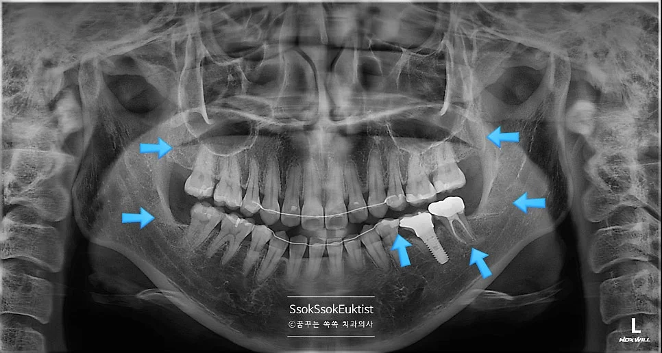 치료 완료 후 결과 3
