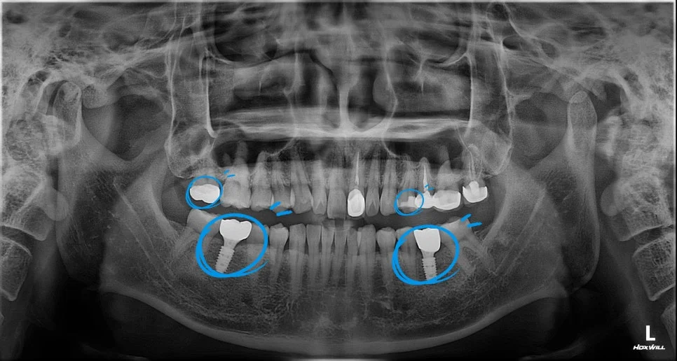 모든 치료 완료 최종 구강 사진