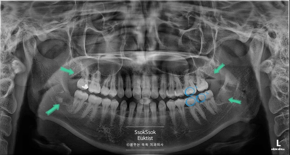 모든 치료 완료 최종 결과 사진