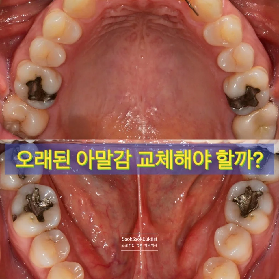 아말감 재료 성분 설명 일러스트 수은 은 주석 구리 혼합