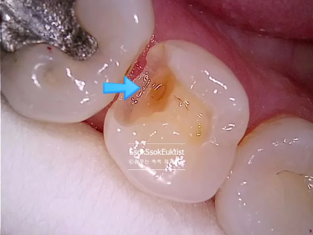 아말감 제거 후 노출된 상아질 표면 임상사진