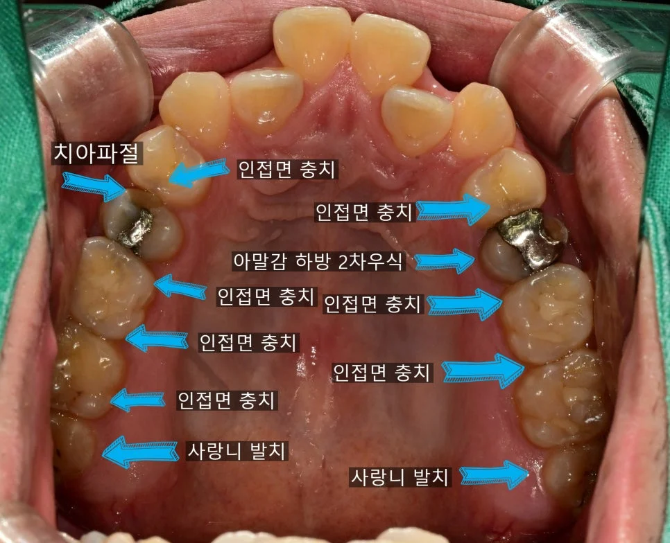 오래된 아말감 2차 충치 임상 사진
