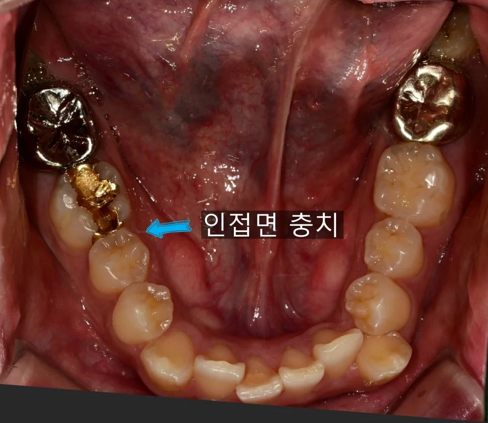 아말감 하부 2차 충치 근접 사진