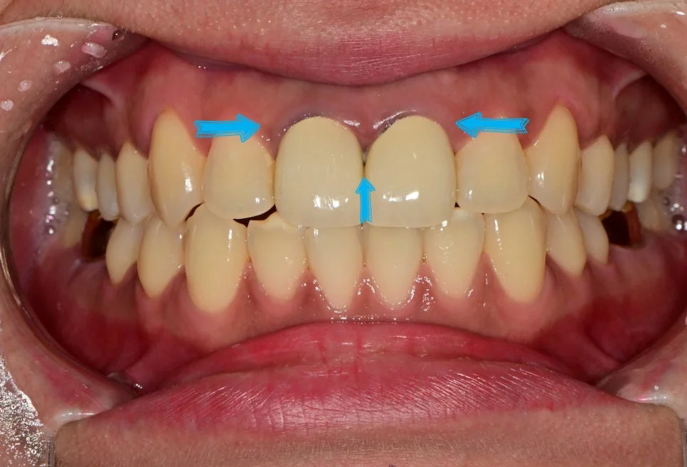 앞니 크라운 잇몸 변색 치료 전 정면 사진