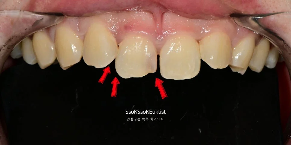 앞니 벌어짐 파절 충치 치료 전 임상 사진