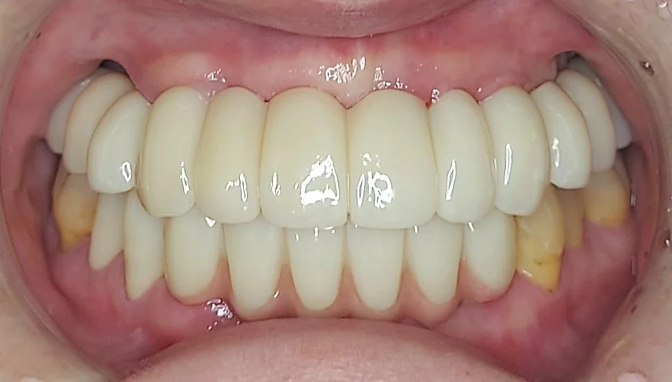 치료 후 CO 교합 확인 구강 전면