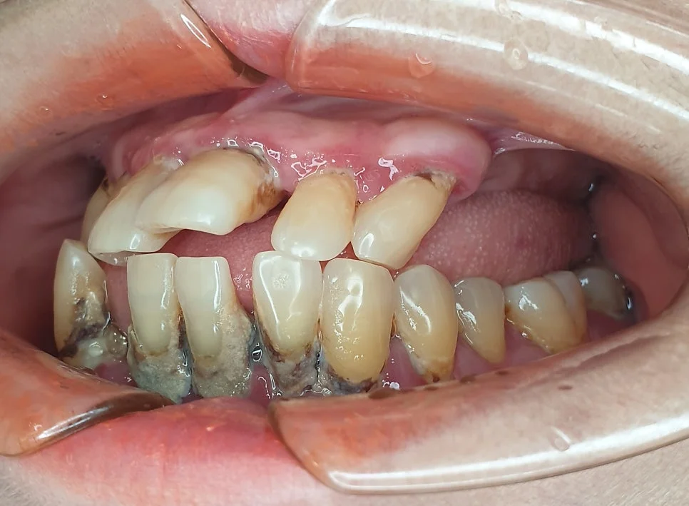 치료 전 구강 측면 사진 - 하악 어금니 치주 및 결손