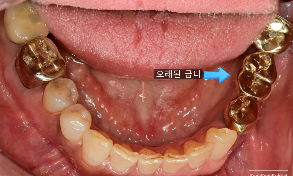 왼쪽 하악 금니 브릿지 2차 충치 진행 상태 임상 사진
