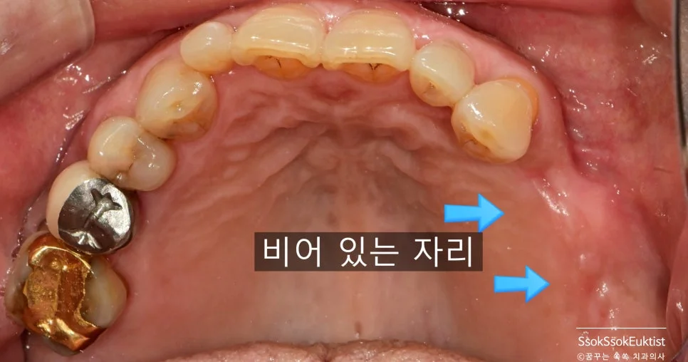 왼쪽 상악 치아 상실 후 잇몸뼈 흡수 상태 임상 사진