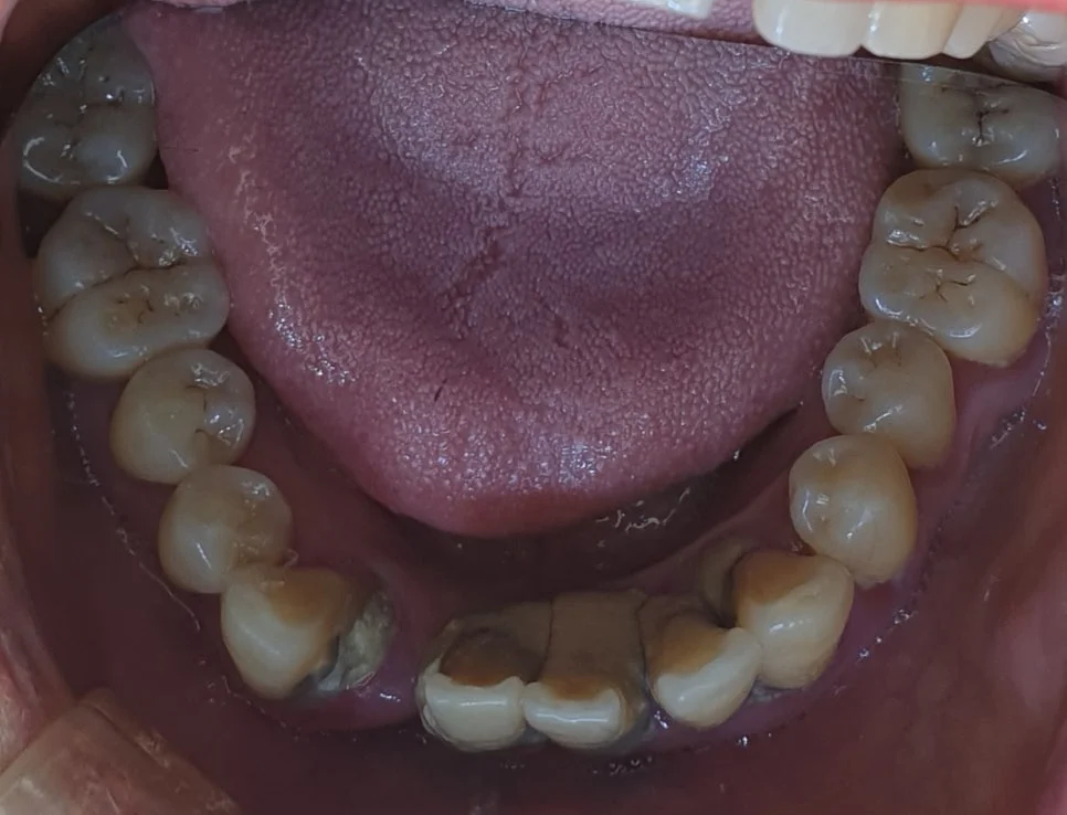 치료 전 하악 교합면 구강사진 - 치주질환 및 결손 다수