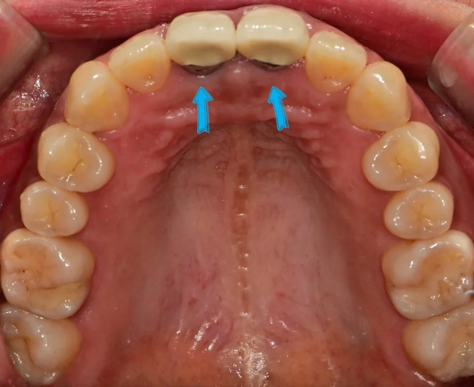 앞니 크라운 잇몸 변색 상방 교합면 사진
