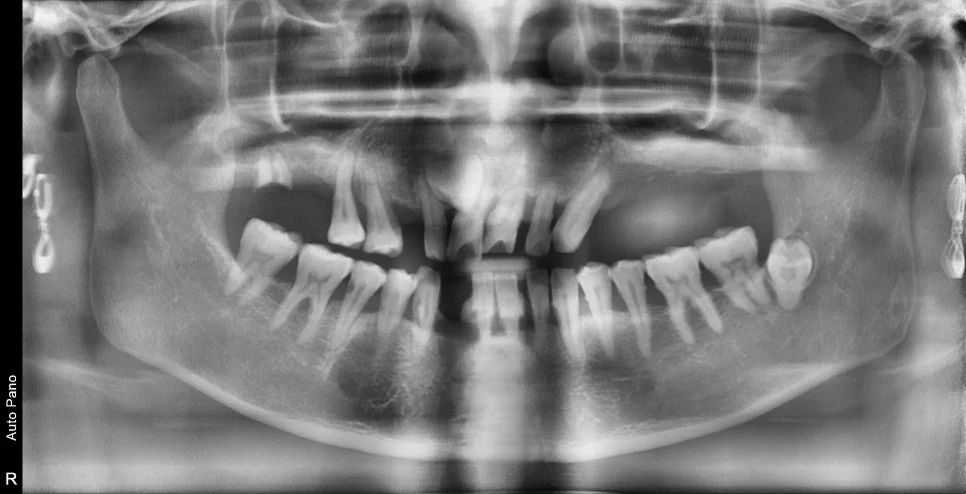 치료 전 파노라마 X-ray - 다수 치아 결손 및 기존 치료 확인