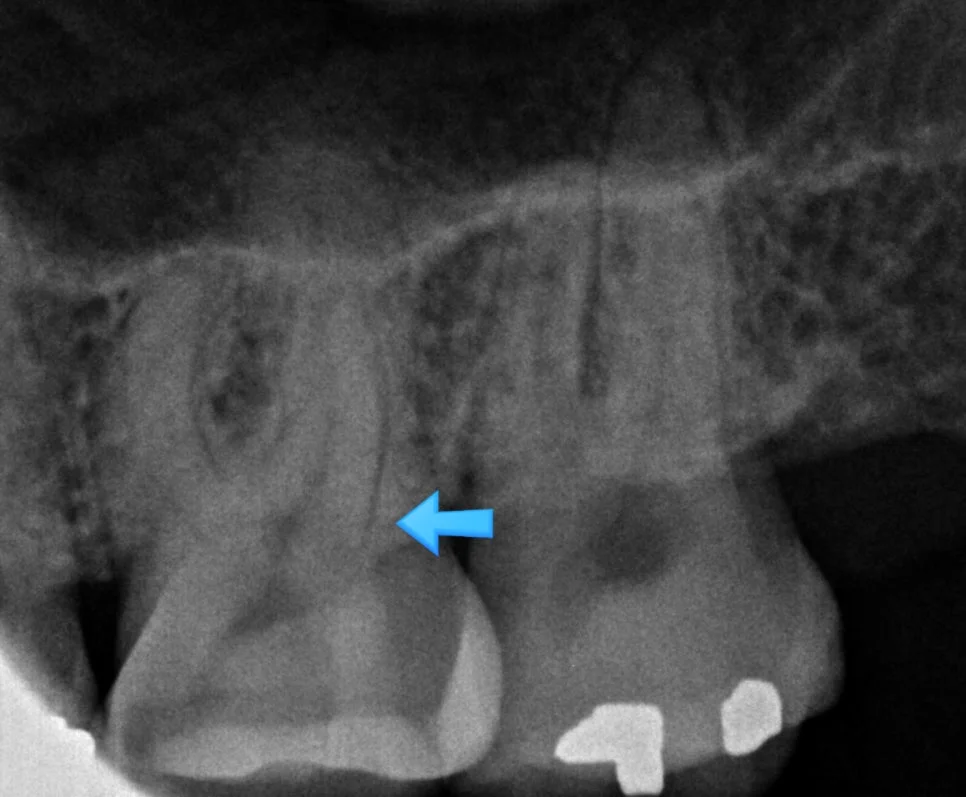 치료 전 치근단 X-ray - 치근단 병변 화살표 표시