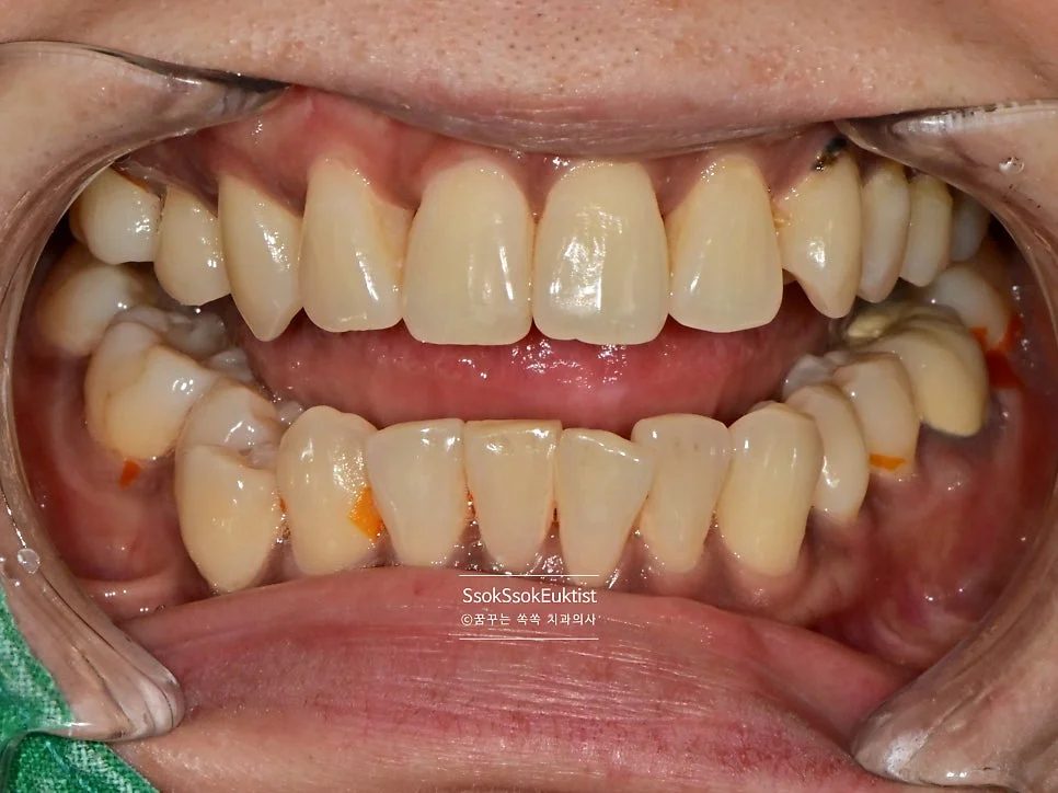 스케일링 전 치석 착색 상태