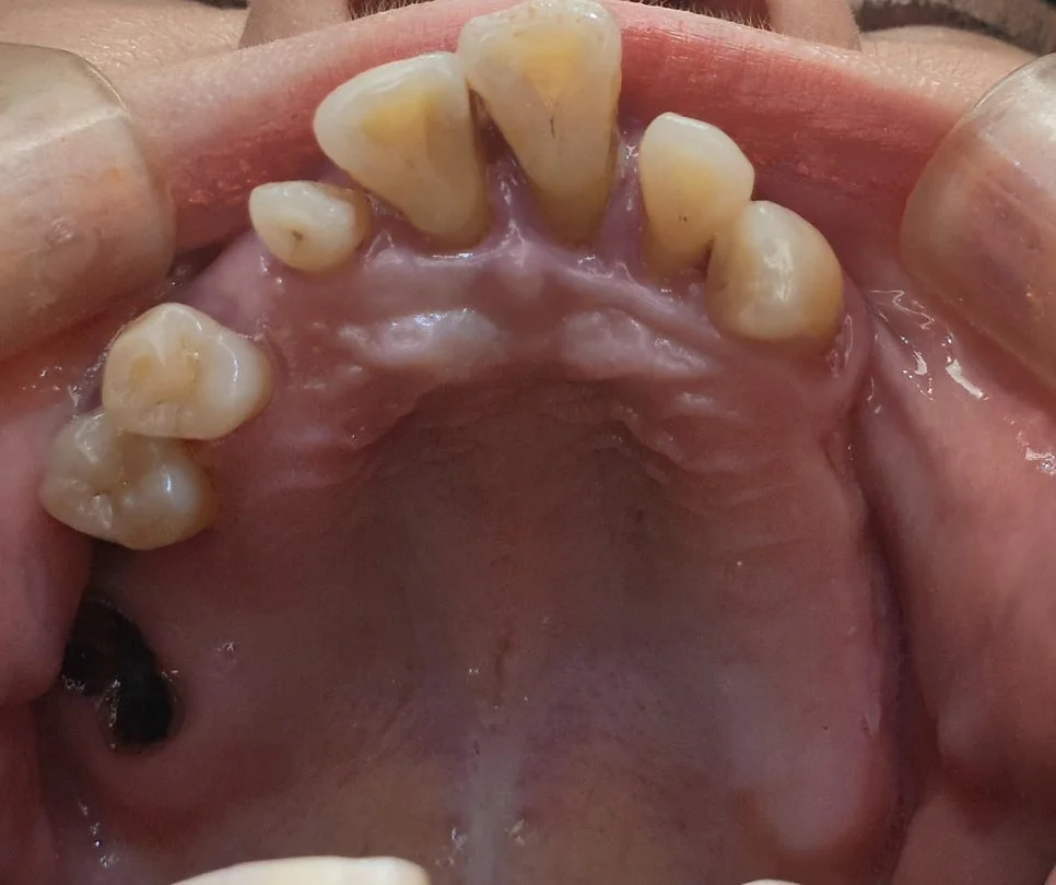 치료 전 상악 교합면 구내사진 - 다수 치아 결손 및 손상 상태
