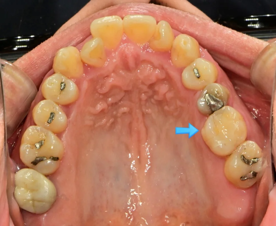 치료 전 상악 대구치 교합면 사진 - 화살표로 대상 치아 표시